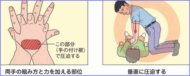 胸部圧迫